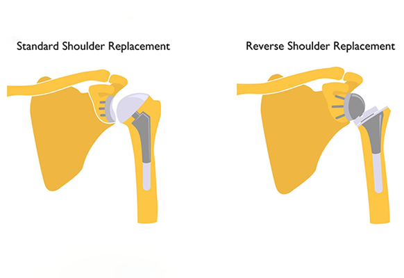 Total and reverse shoulder replacement diagram