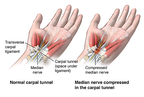 Illustration of a compressed median nerve in the carpal tunnel