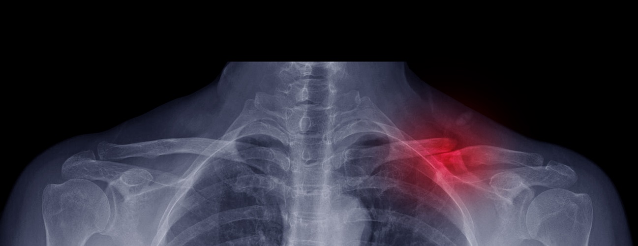X-ray of clavicle fracture