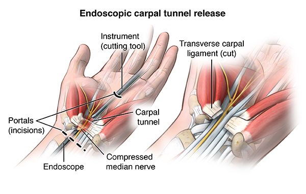 Illustration of the endoscopic carpal tunnel release procedure