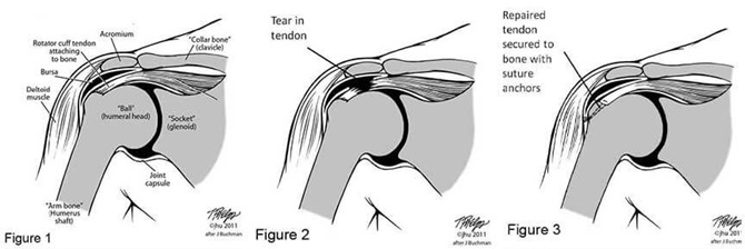Different Types of Rotator Cuff Surgery