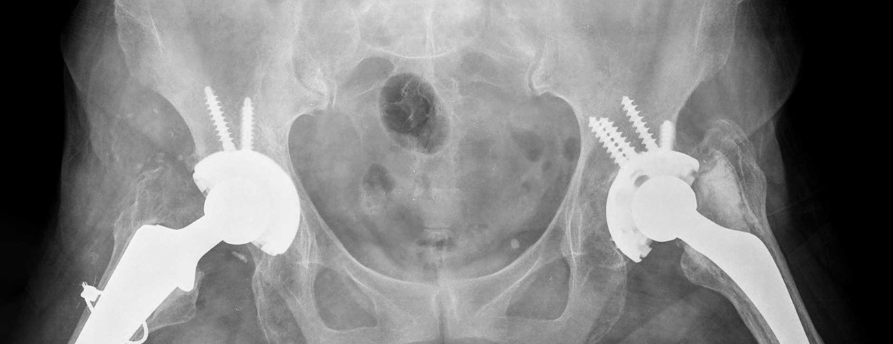 hip replacement surgery hero
