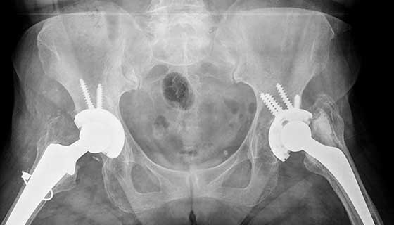 x-ray of total hip replacement surgery