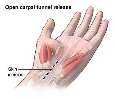 Illustration of the open carpal tunnel release procedure
