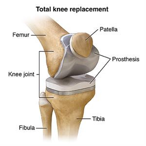 Knee Replacement Physiotherapy
