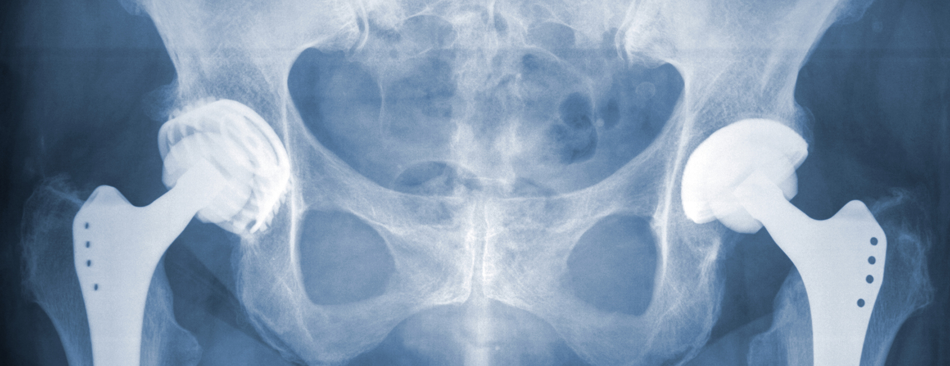 Total Hip Replacement: Anterior Approach | Johns Hopkins Medicine