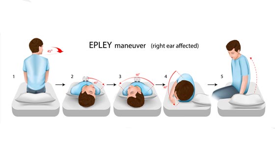 Vertigo Treatment Epley Maneuver Exercises Benign Paroxysmal Vertigo Treatment Epley Maneuver Exercises Benign Paroxysmal