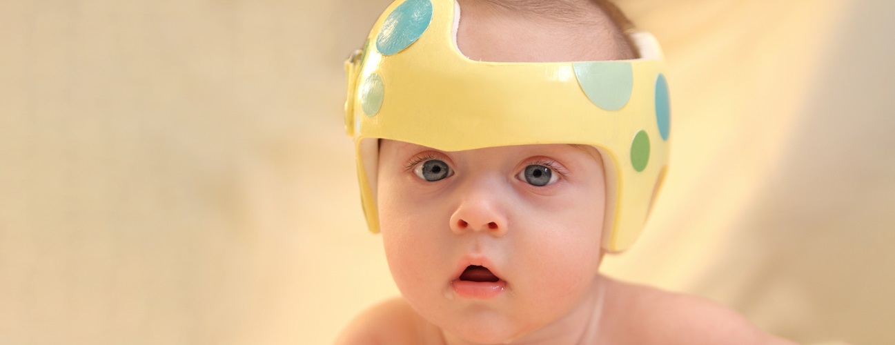 A baby wears a cranial remolding helmet.