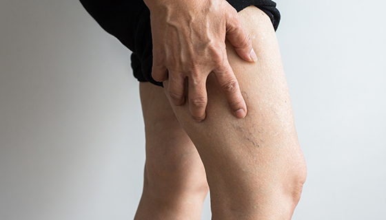 A person clutches at their leg, which has visible varicose veins.
