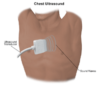 Illustration of a chest ultrasound procedure