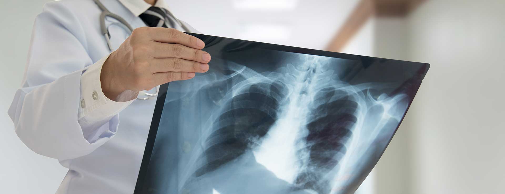 doctor observing lung xray