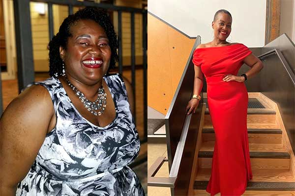 Patient Joval before and after her bariatric surgery
