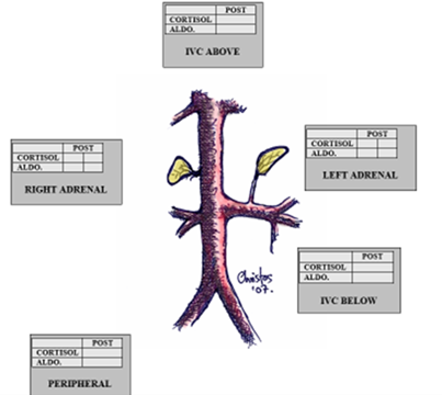 an illustration of adrenal venous sampling results