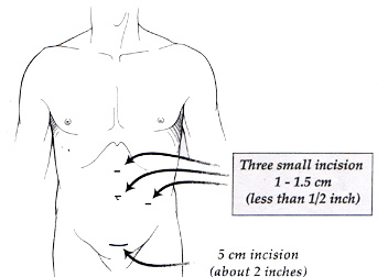 Diagram of laparoscopic incision, showing four small spots across the abdomen