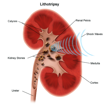 Illustration of lithotripsy