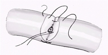 Illustration of a two-layer closure