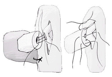 Illustration of microsurgical end to side intussusception technique