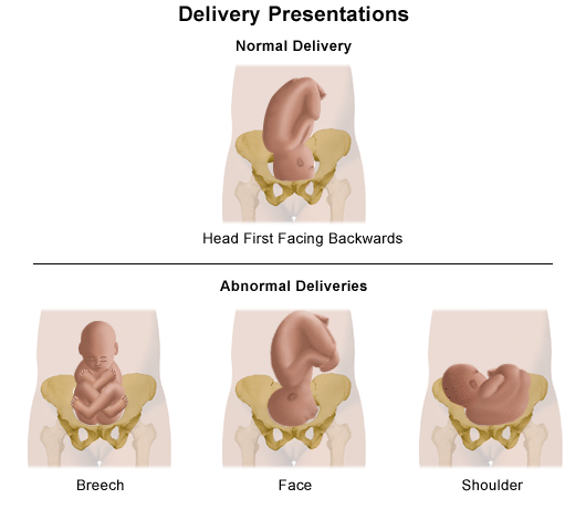 An illustration of normal and abnormal delivery presentations.