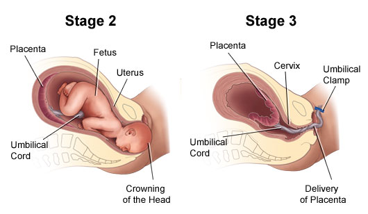 An illustration of the second and third stages of labor.