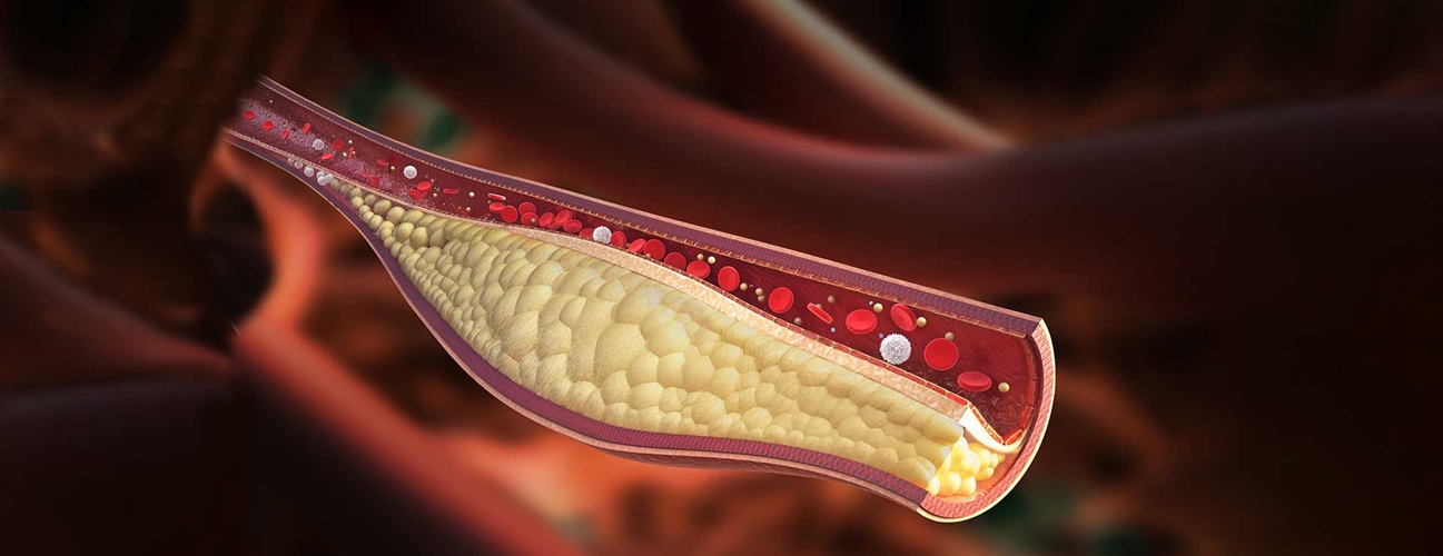 illustration of a blood vessel clogged by cholesterol buildup