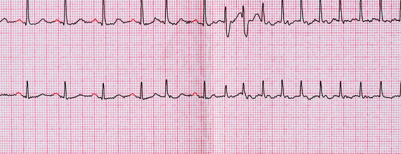 electrocardiogram printout showing heart rhythm