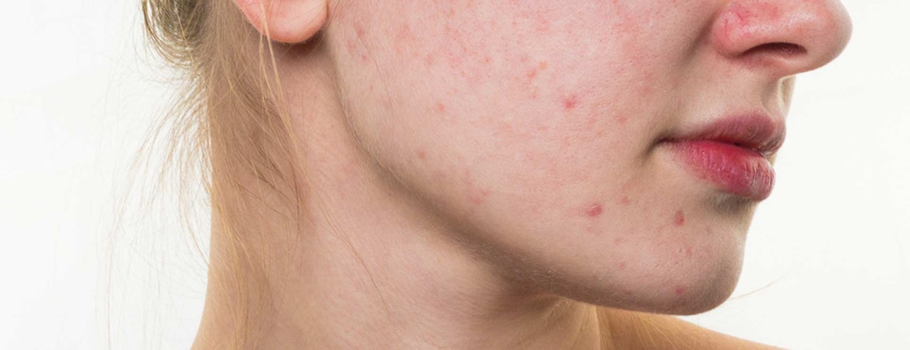 Woman with adult acne