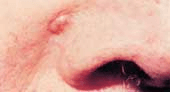Image example of basal cell carcinoma