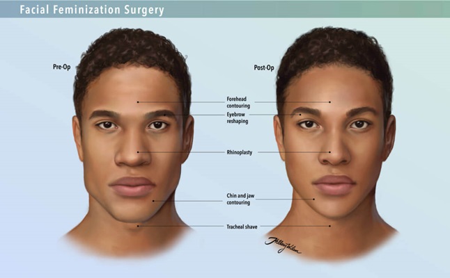 Hillary Wilson's illustrations of gender affirming surgery detailing facial feminization.