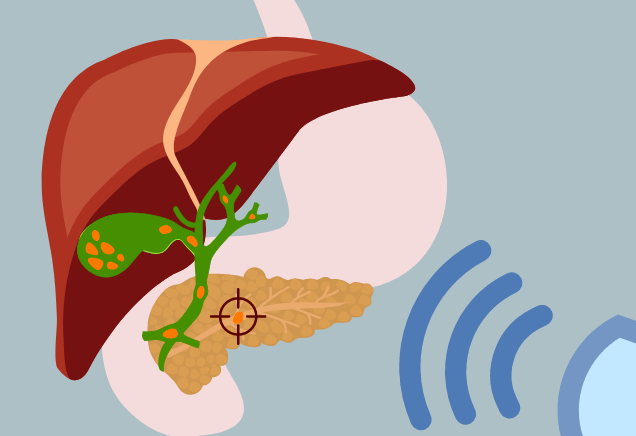Illustration of a lithotripsy device targeting a pancreas