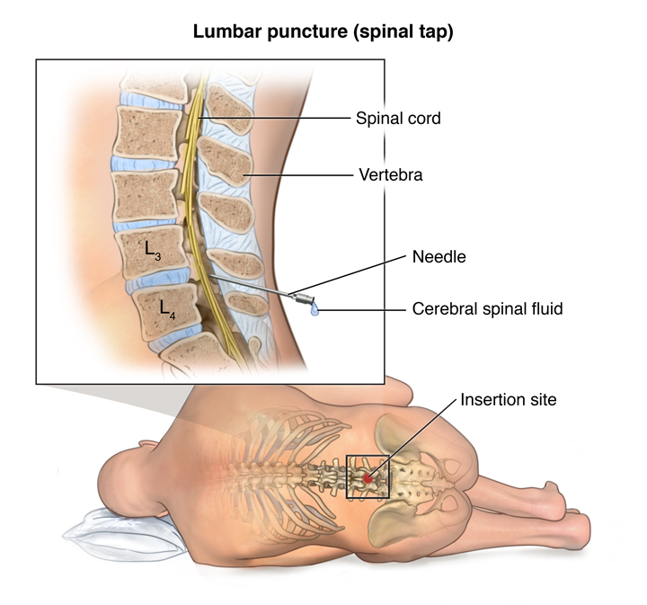 lumbar puncture, spinal tap