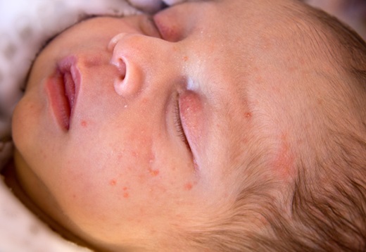 an infant with a rash on his face
