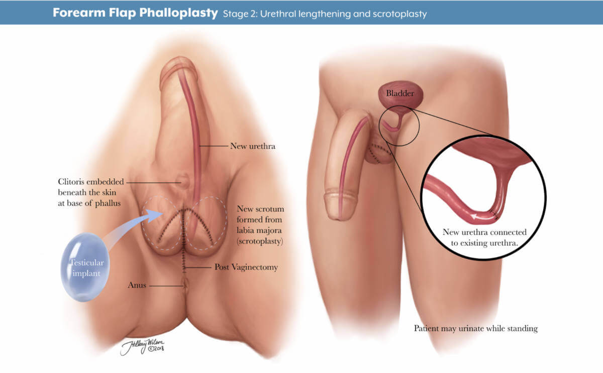 Hillary Wilson's illustrations of gender affirming surgery detailing phalloplasty urethral lengthening and scrotoplasty.