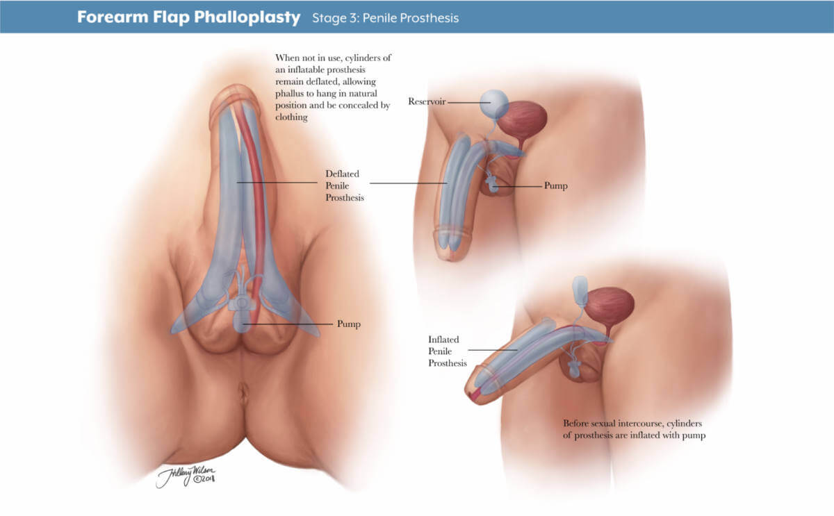 Hillary Wilson's illustrations of gender affirming surgery detailing phalloplasty, penile prosthesis.
