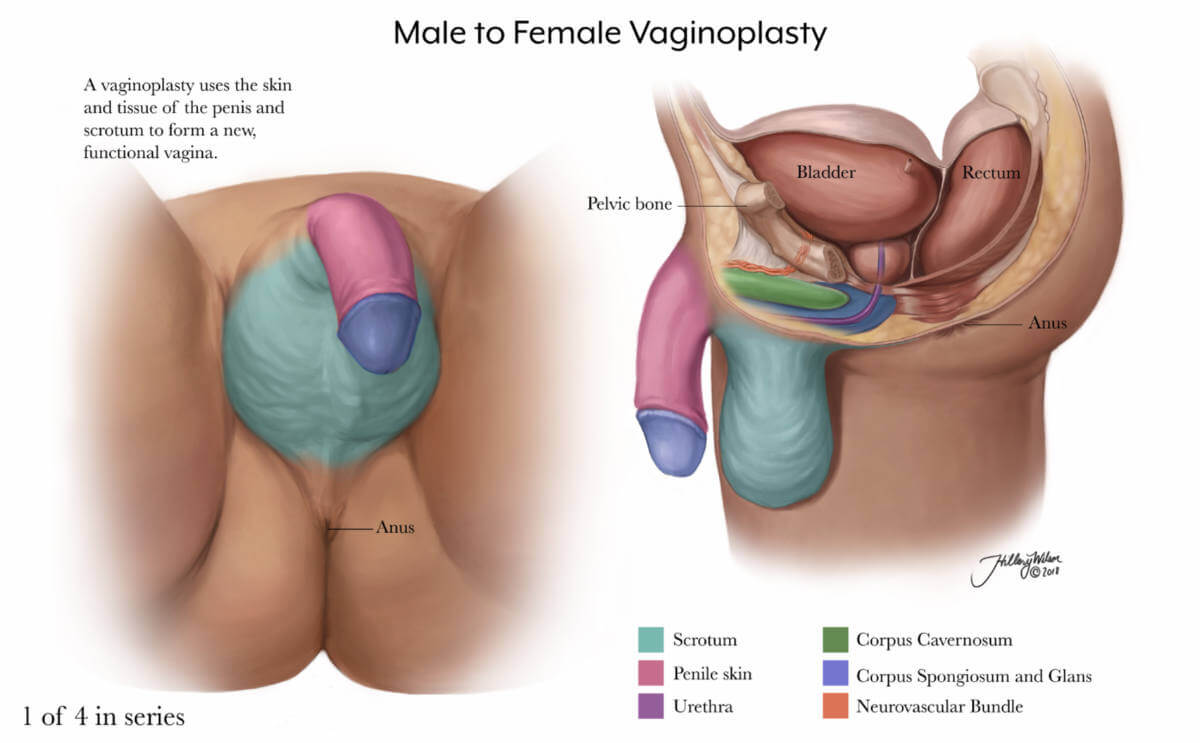 Hillary Wilson's illustrations of gender affirming surgery detail the first slide of male to female vaginoplasty.