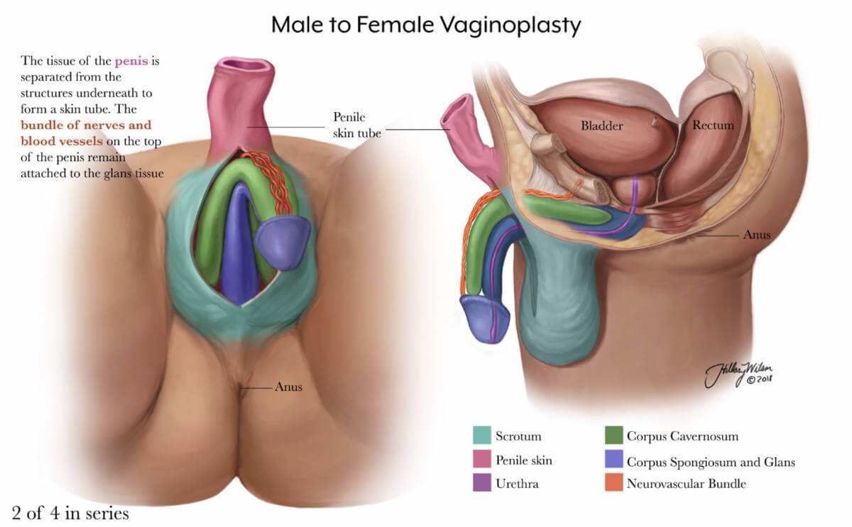 Hillary Wilson's illustrations of gender affirming surgery detail the second slide of male to female vaginoplasty.