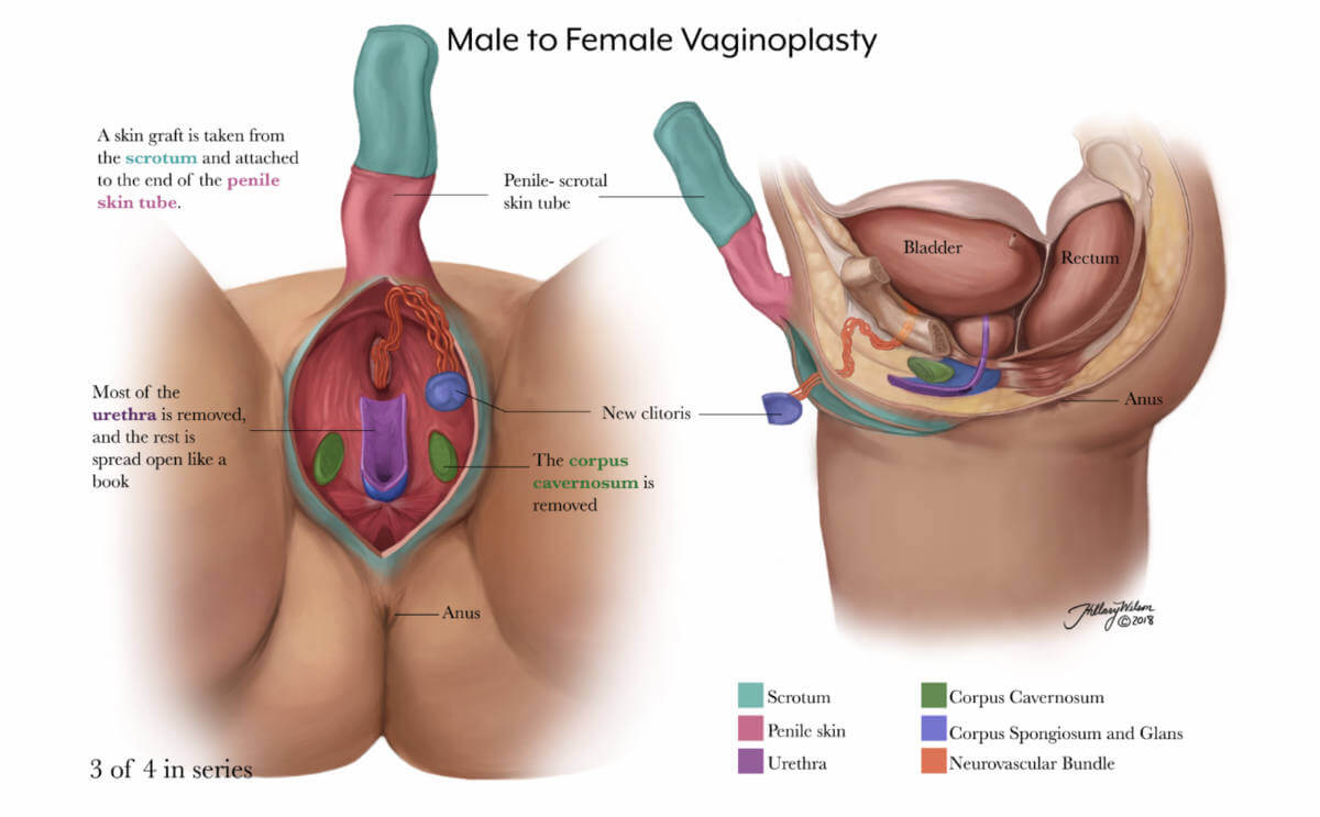 Hillary Wilson's illustrations of gender affirming surgery detail the third slide of male to female vaginoplasty.