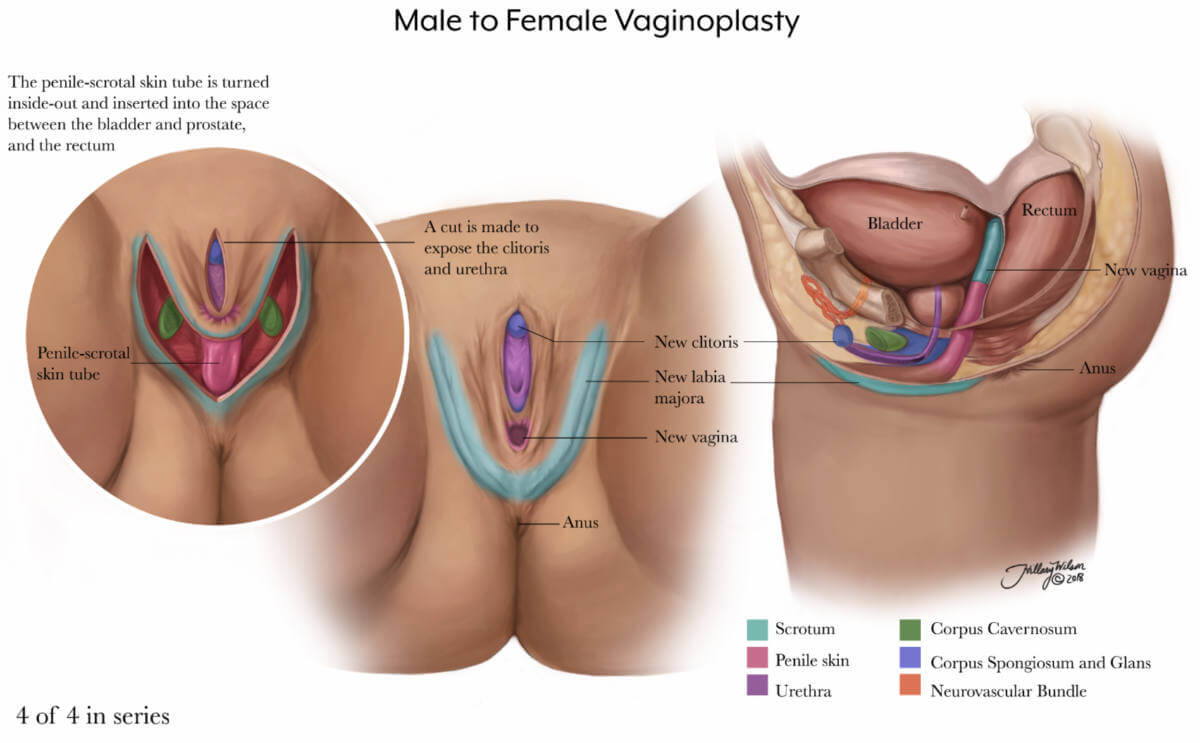 Hillary Wilson's illustrations of gender affirming surgery detail the final slide of male to female vaginoplasty.