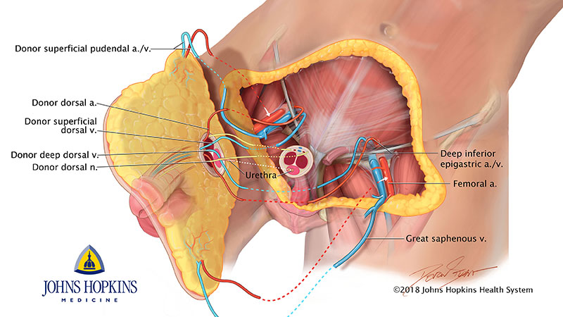 PENILE AIDE EXTENSOR PENE