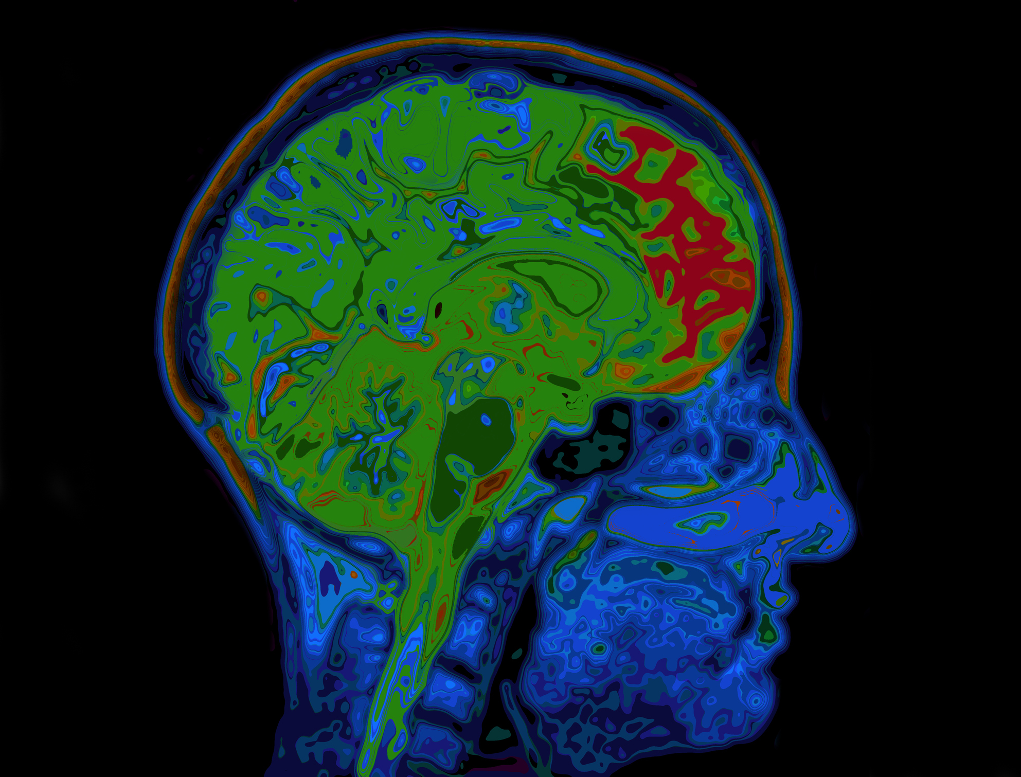 9-27-2018 MRI Chanapa Scan_Brain_Anatomy_iStock-522798525