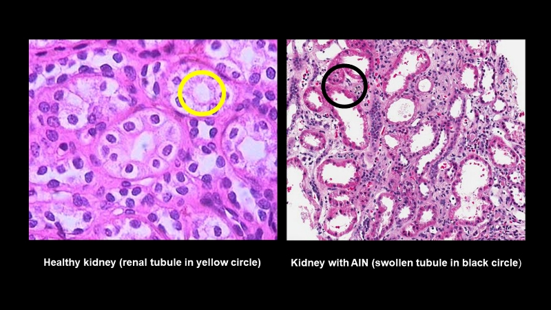 800 Normal Kidney and AIN