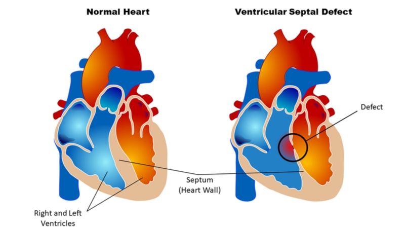 800 Normal and VSD Hearts Public Domain via Wikipedia