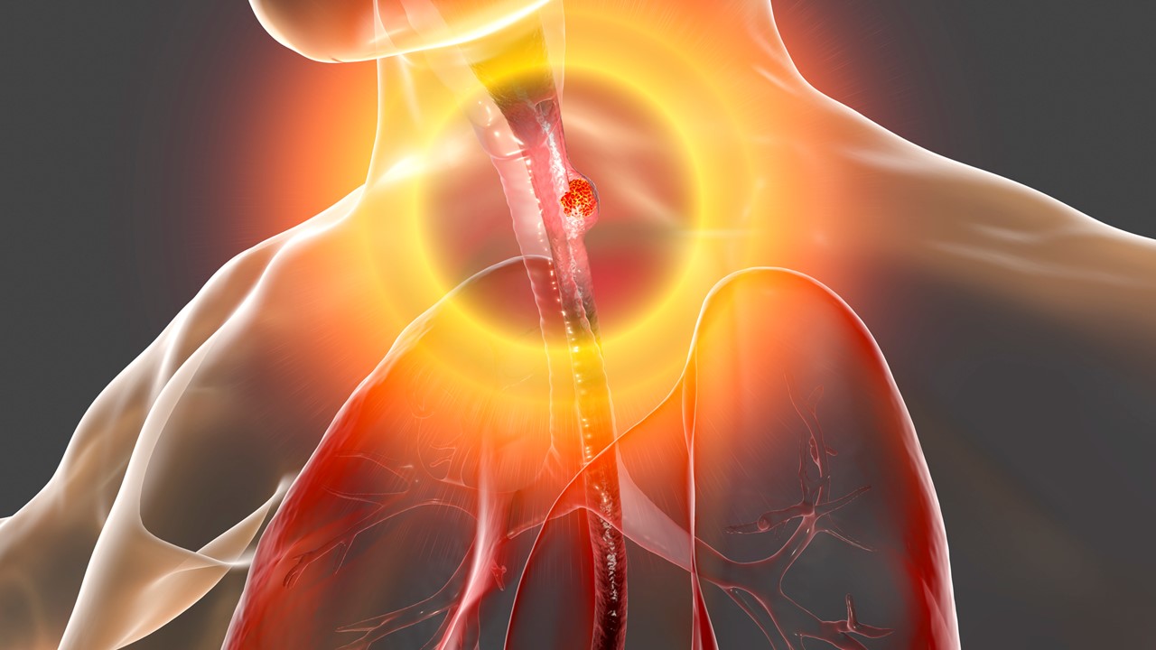 Key Data: TRPV1 Inhibition vs. Standard GERD Therapies Key Data: TRPV1 Inhibition vs. Standard GERD Therapies
