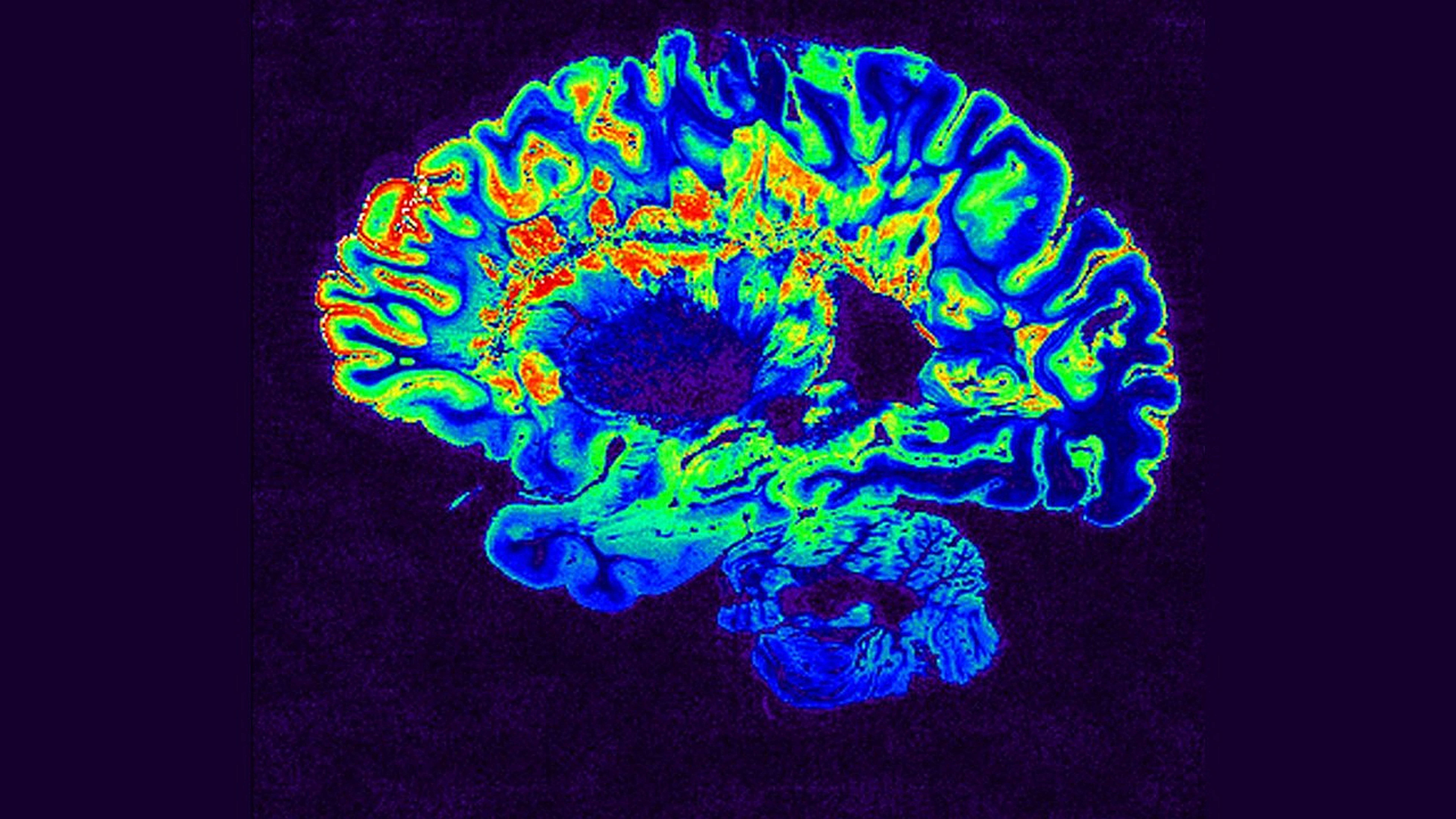 MRI of brain with brain lesions