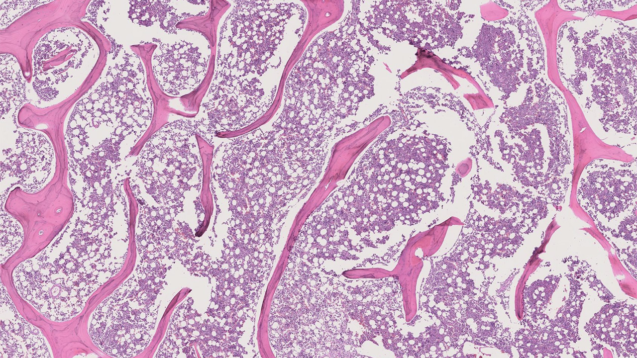 A microscopic image of intramedullary osteosarcoma