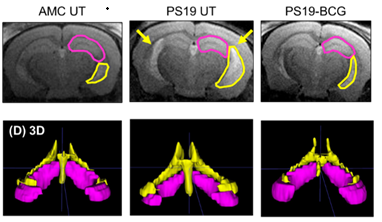 Study Advances Mechanistic Insight into Tuberculosis Vaccine’s Link to Reduced Dementia Risk 
