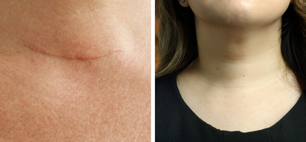 On the left, a traditional thyroidectomy scar across the neck. On the right, Kristin's neck, four weeks after her scarless thyroidectomy procedure.