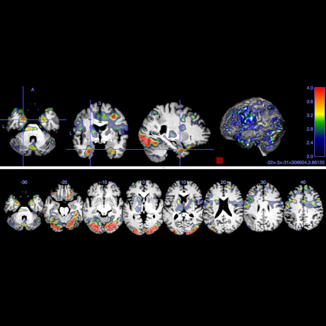 fmri-for-electrode-positioning