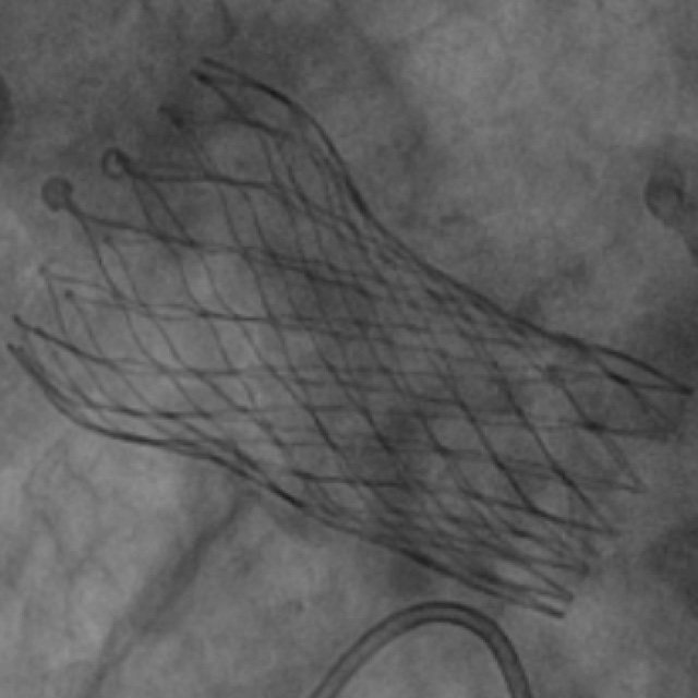 A fluoroscopic image shows the self-expanding TAVR platform.