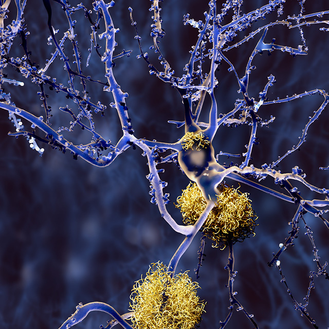 A graphic shows amyloid buildup in nerves.