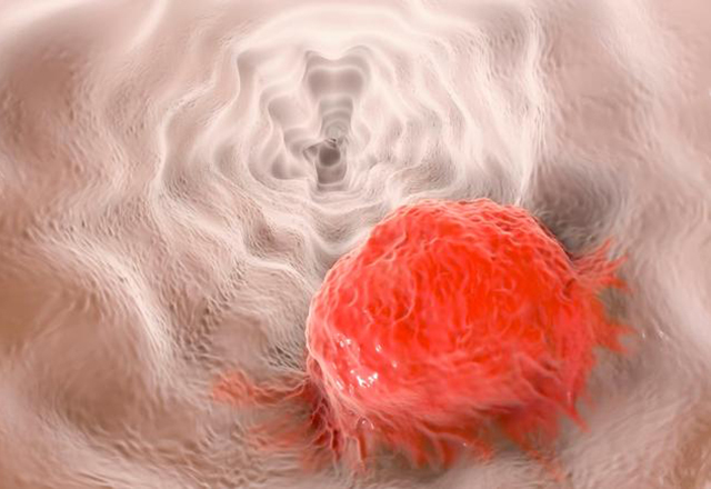 esophageal cancer